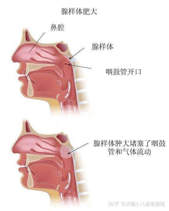 四,儿童腺样体轻度增大,正常现象