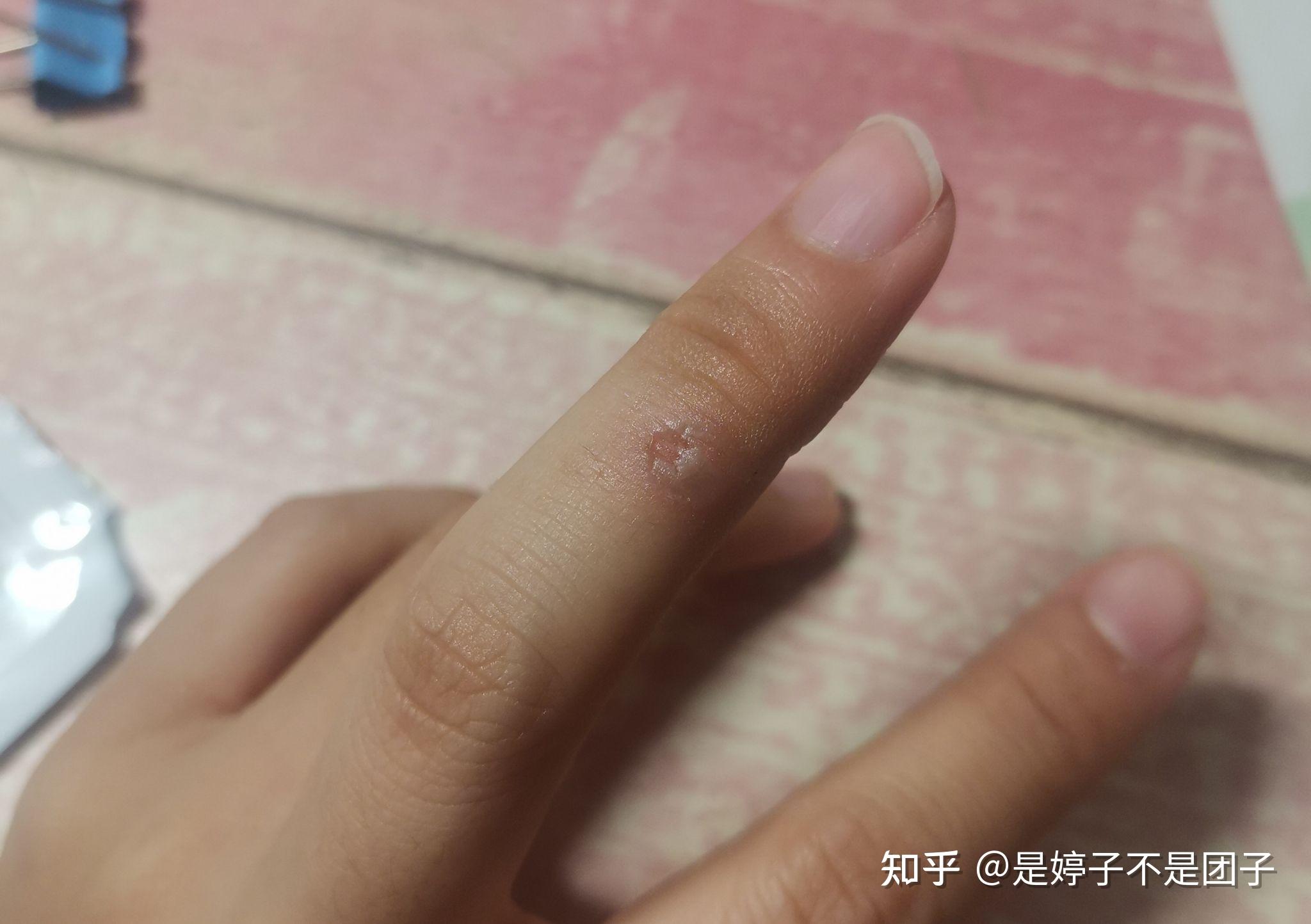 被电烙铁烫伤是一种什么样的体验怎么处理不易留疤