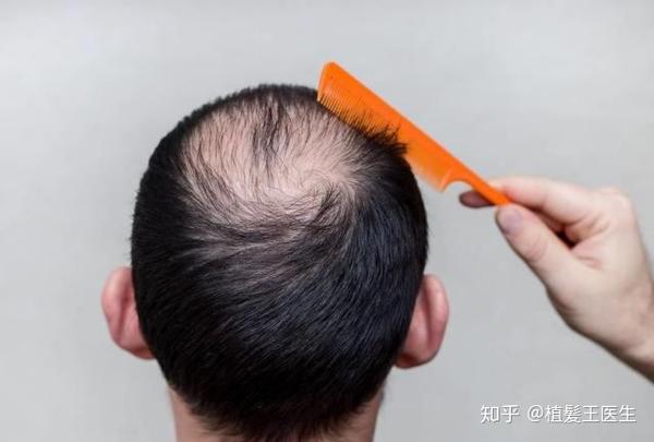 科普:7种脱发类型及其拯救方法