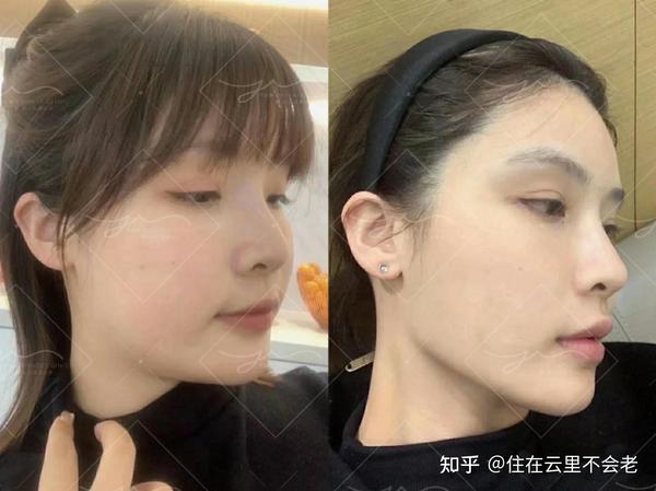 所以害怕瘦脸针打出面颊凹陷的姐妹可以选择下颌缘提升把清晰的轮廓线