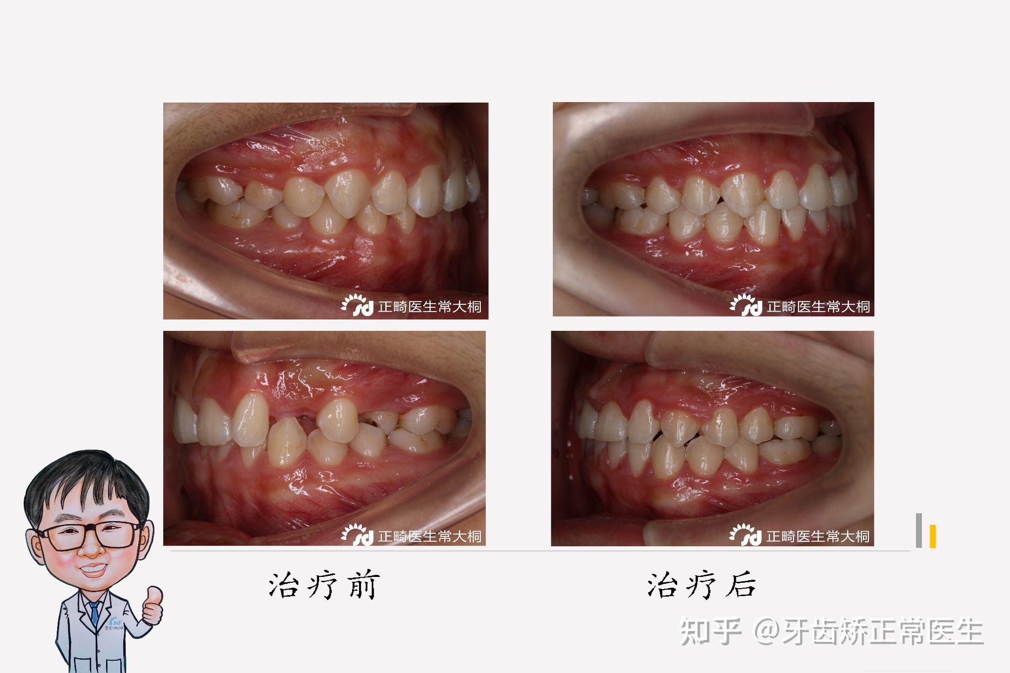 郑州隐适美矫正常大桐牙齿异位伴深覆合