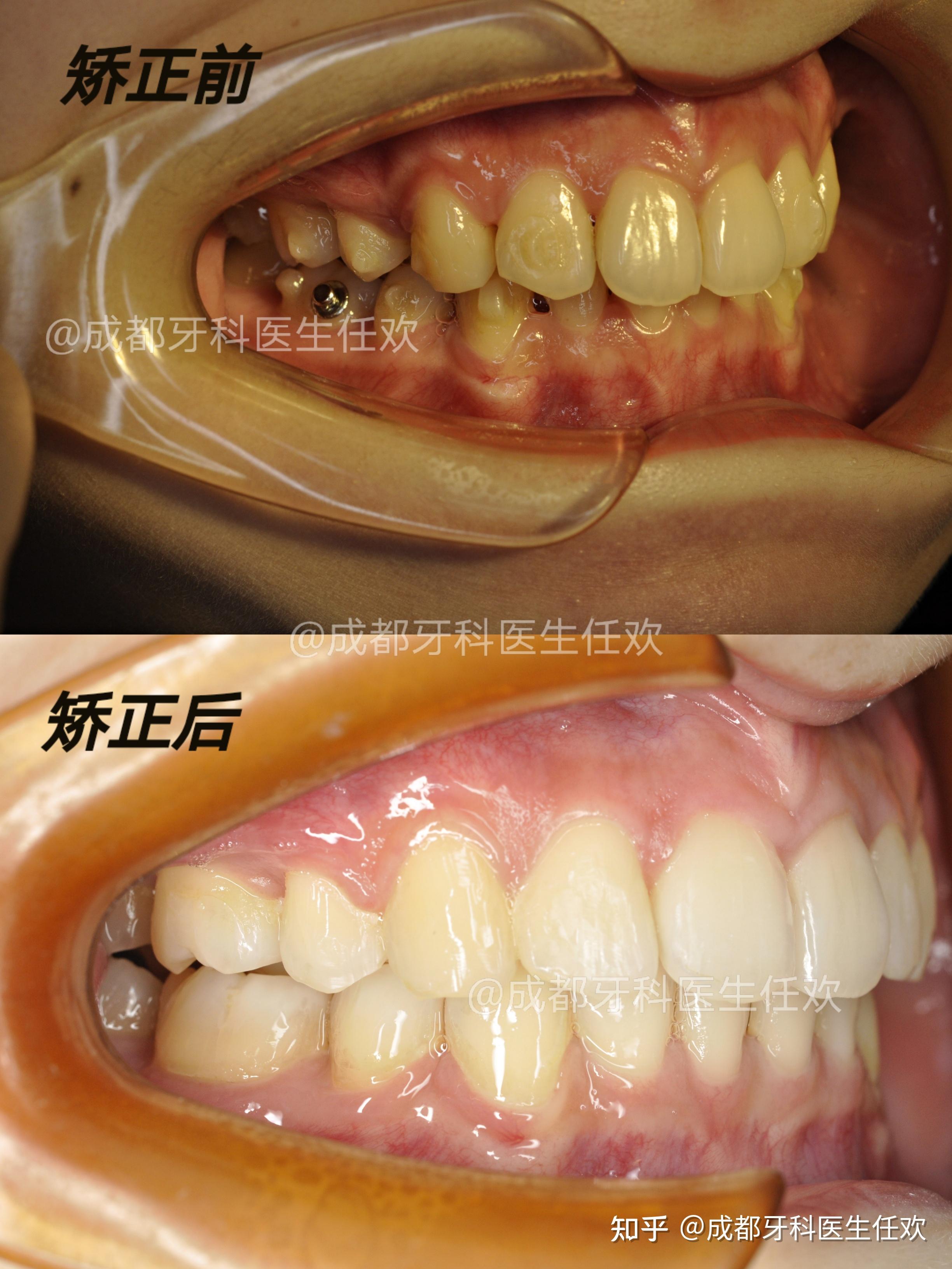 牙齿矫正正畸牙列不齐深覆合