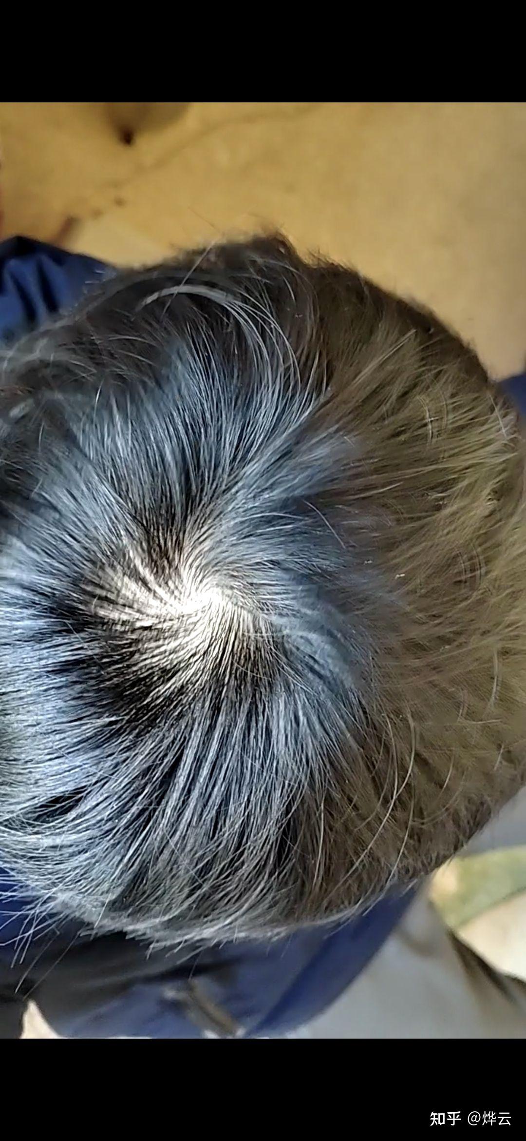 什么样子的发旋是正常的啊