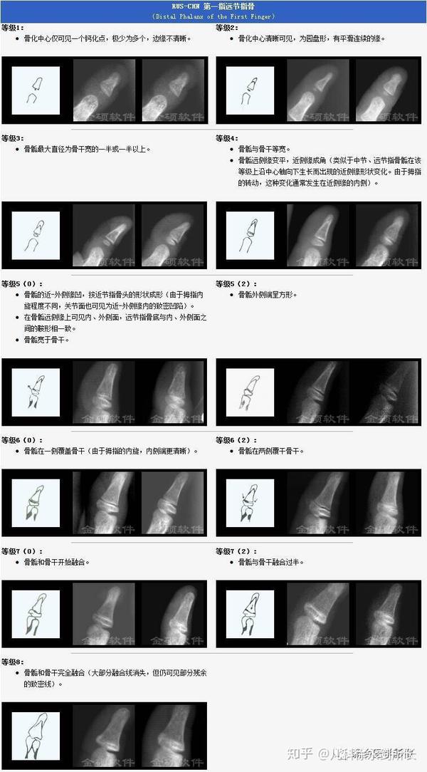 【中华05标准】解析儿童骨龄片等级划分