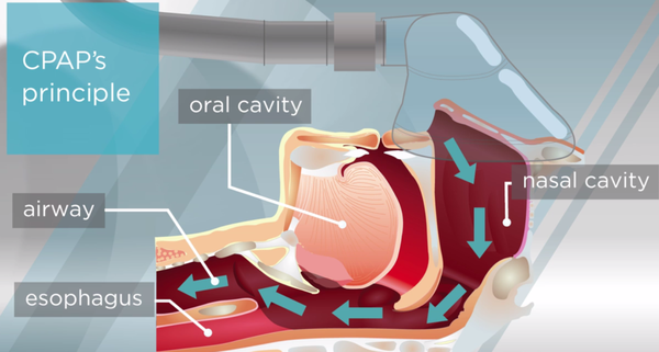 单水平呼吸机cpap工作原理