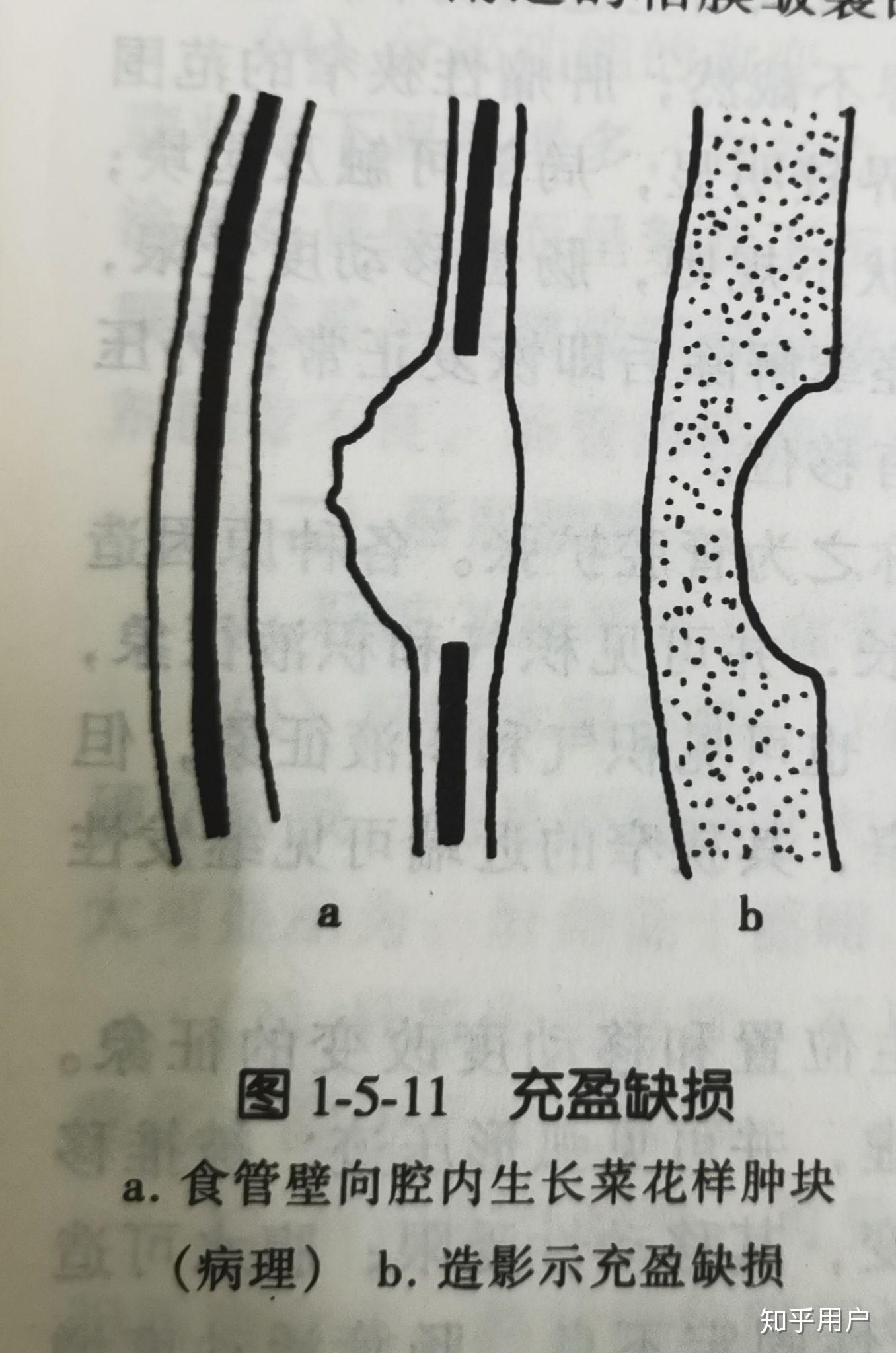 充盈缺损 知乎