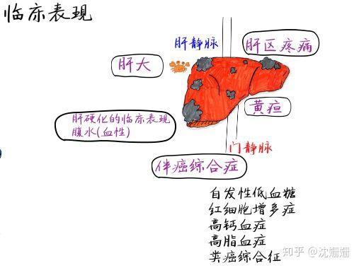 手绘视频原发性肝癌