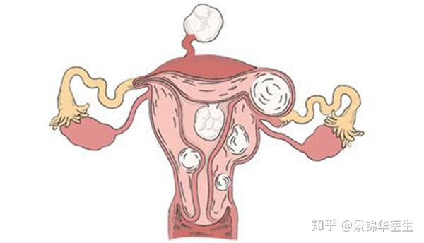 大,会使宫腔变形,如此一来,不仅精子很难通过,受精卵着床也会受到影响