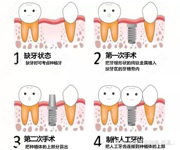 种植牙的过程是什么样的?