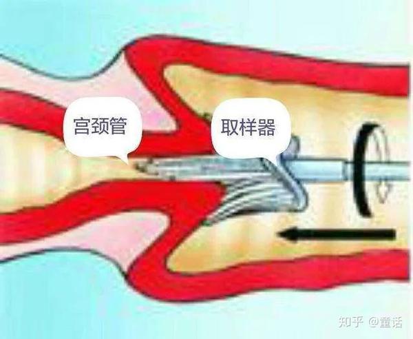 医生会用上图中的小刷子,把宫颈表面以及宫颈管里的一些脱落的细胞给
