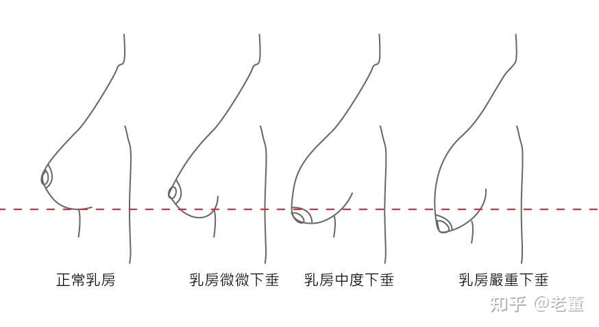 (科普:四级类手术是高难度,综合性的手术) 胸部偏大,胸部下垂,大小胸