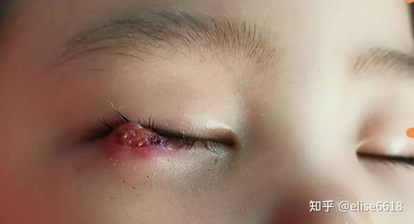如何快速去除麦粒肿散粒肿不吃药不手术
