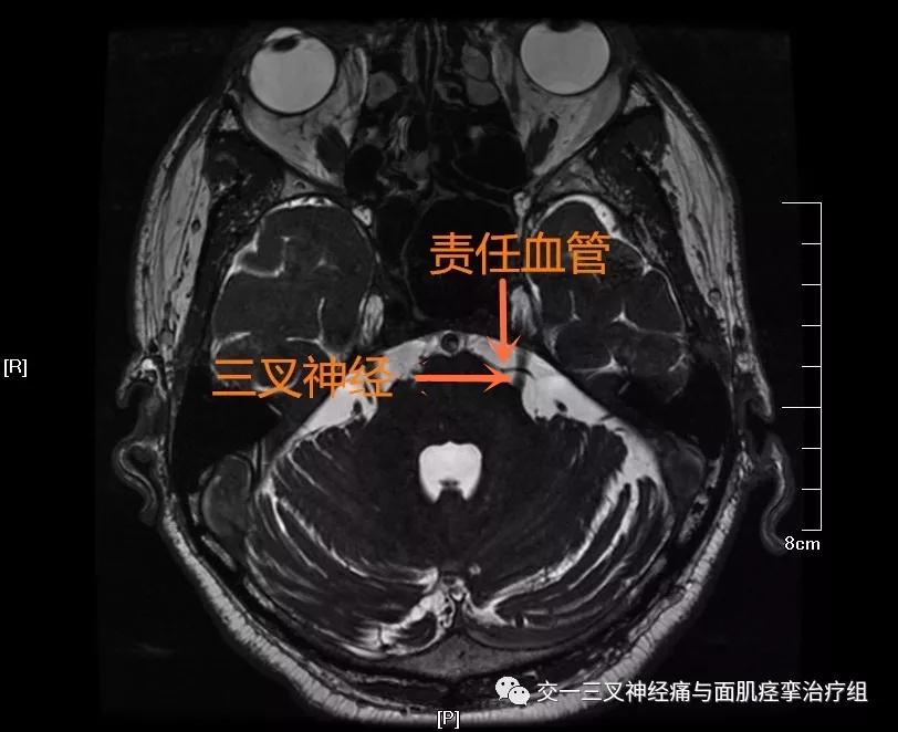 三叉神经痛,面肌痉挛手术前的主要影像学检查