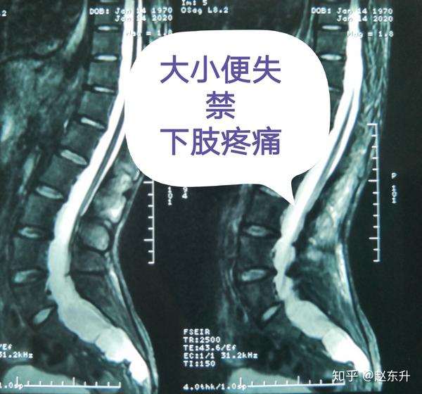 大小便失禁伴下肢疼痛原来是骶管囊肿合并脊髓栓系惹的祸.