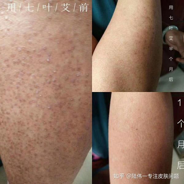 毛周角化症是什么?小陆告诉你