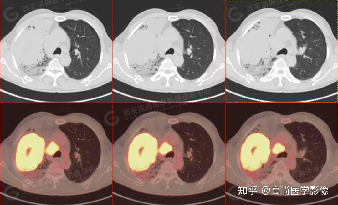 PET CT病例肺鳞癌5例高尚医学影像 知乎