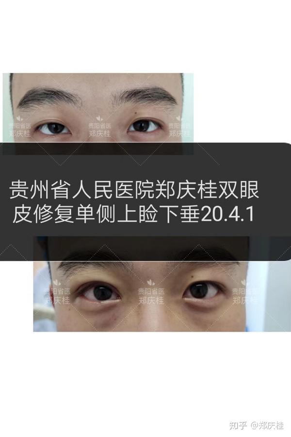 单侧上睑下垂,提肌无力双眼皮修复手术