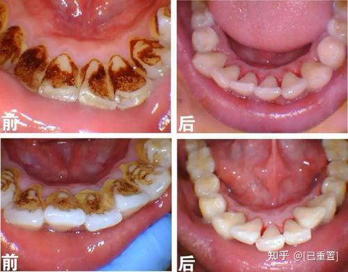 牙医总让你洗牙,到底是为啥?