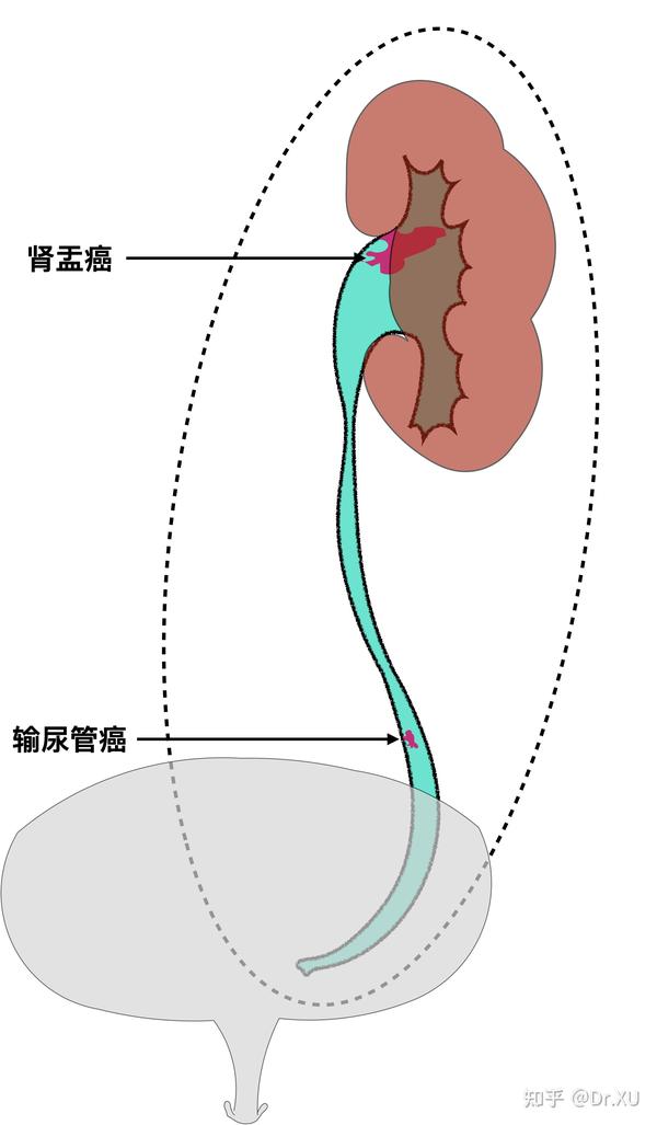 输尿管全长及输尿管开口周围部分膀胱壁