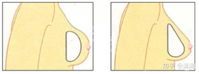 水滴型(解剖型)假体和圆盘型假体植入乳房后形态