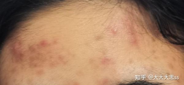 想问一下我这样的皮肤状态是属于细菌感染还是普通的痤疮呢?