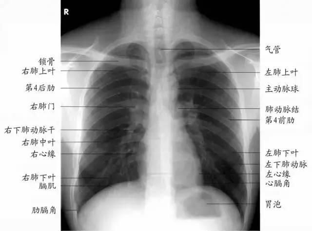 拍个胸片肺纹理增多别慌看这里