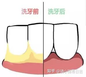 误区二:洗牙会让牙齿敏感