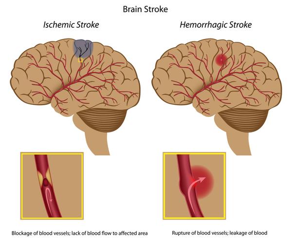 缺血性脑卒中(左)与出血性脑卒中(右),图片引自interactive-biology.