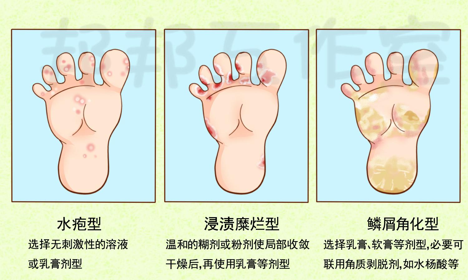 一个女孩的脚为什么会很臭