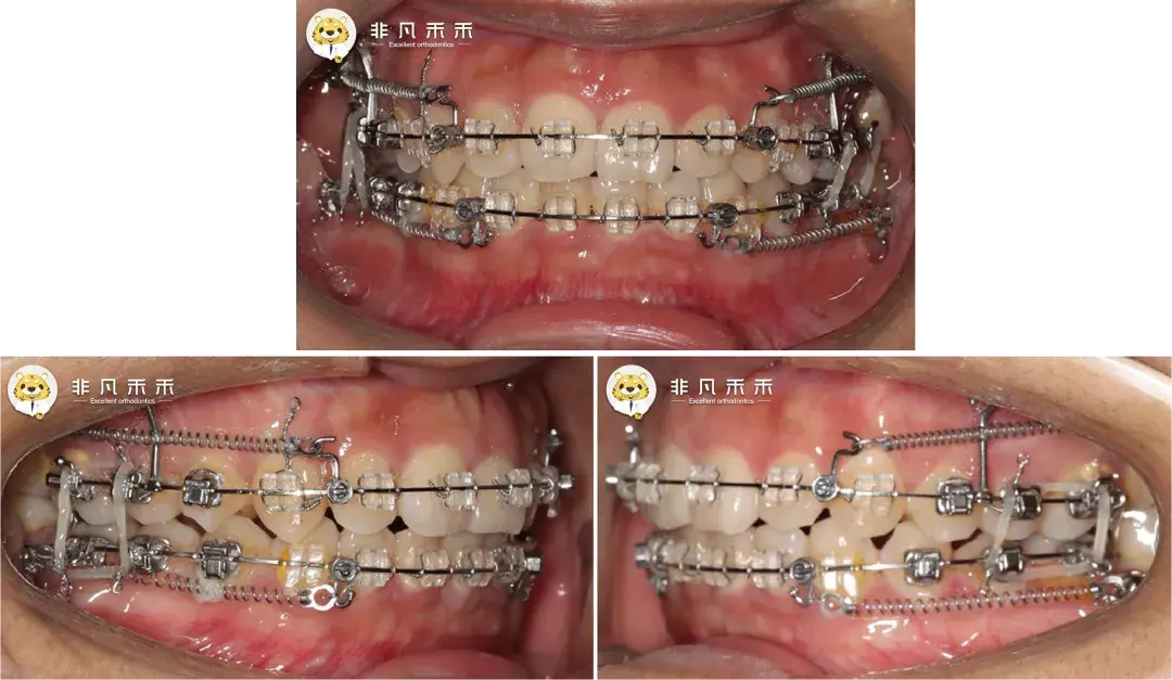 负转矩2,不拔牙矫治1,非凡禾禾蓝宝石单晶托槽矫治计划:5,内收前牙4