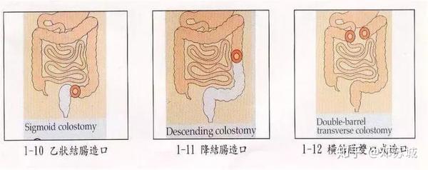 按结构分: 大肠造口: 乙状结肠,横结肠,升结肠,降结肠 小肠造口: 回肠