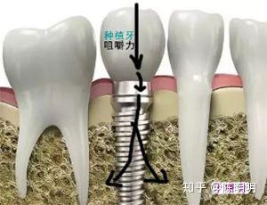 种植 种植牙就是在牙床上植入一个人工金属"牙根",待牙根与牙床稳固