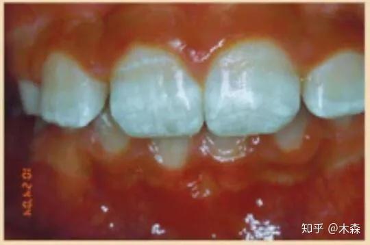 乳糜泻孩子的牙釉质缺陷是对称的——在牙列的四个部分(门牙,犬齿,小