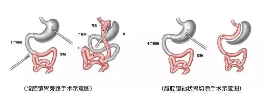 减重手术为何能治疗代谢综合征