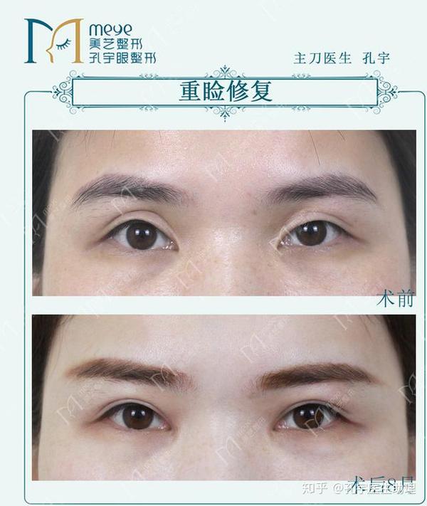 做了平行双眼皮不好看,可以修复成扇形双眼皮吗?