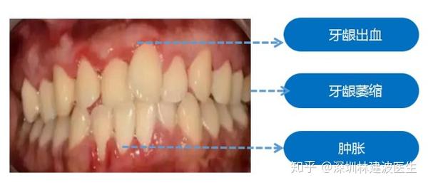 口腔科普为什么口腔疾病频发原来牙龈萎缩是罪魁祸首健康的牙龈是什么