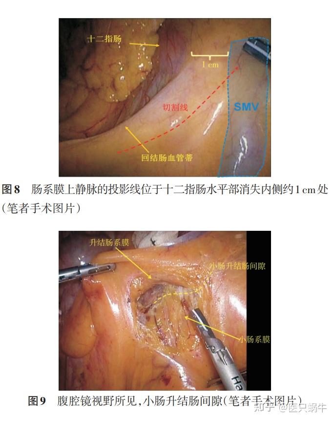 池畔专题结直肠解剖图谱及手术技巧分享01