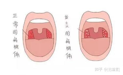 耳鼻喉科孙国政医生:扁桃体炎治疗的预后效果怎么样?