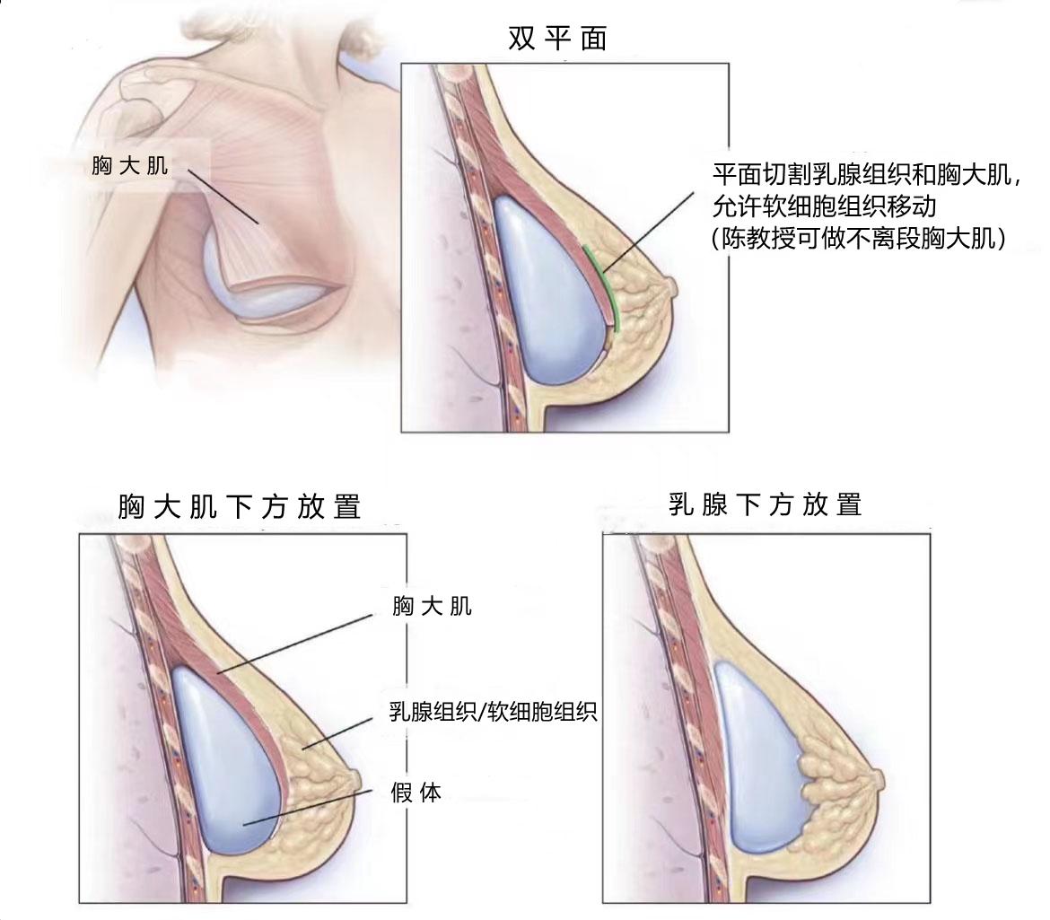 什么是隆胸的层次如何选择假体植入的层次