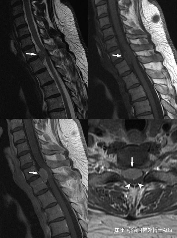 胸椎管内髓外硬膜下脊膜瘤,t1wi呈等信号,t2wi呈稍低信号,增强扫描呈