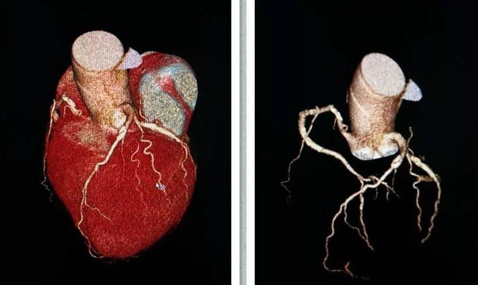心血管冠状动脉比较解剖