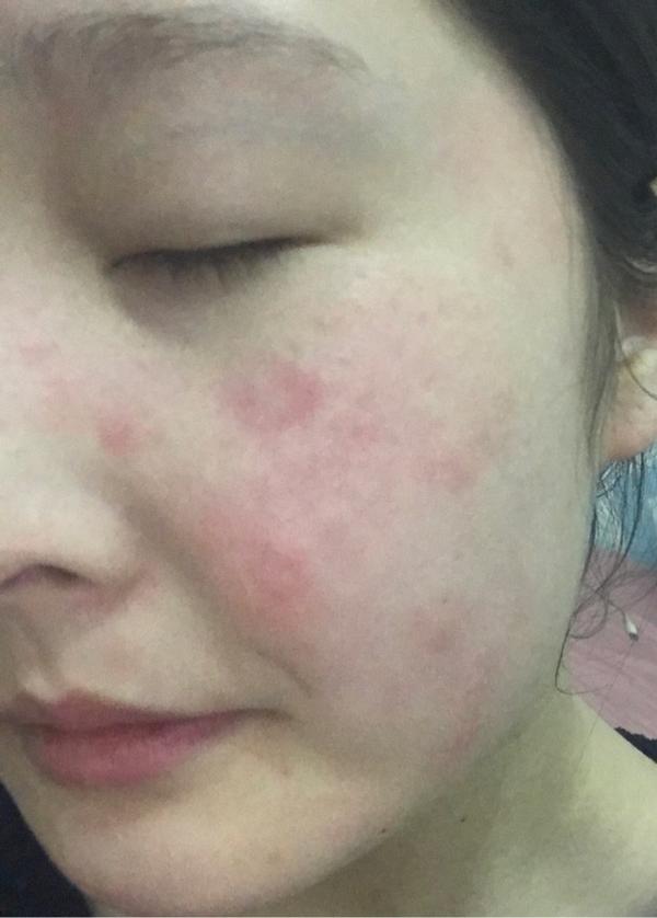 最近脸上长了一坨不痛不痒的红片?