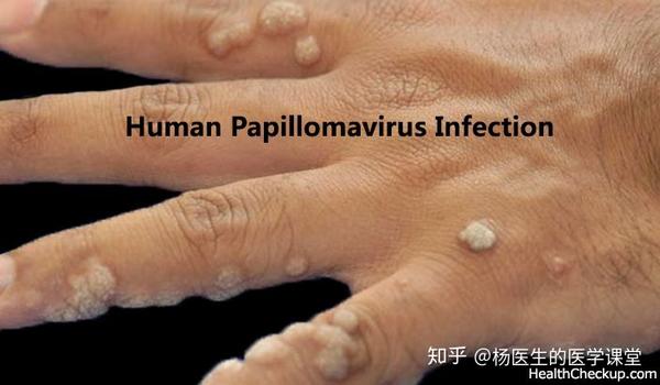 staus从普通疣体(俗称"瘊子")浸出液中观察到人乳头瘤病毒(hpv)颗粒