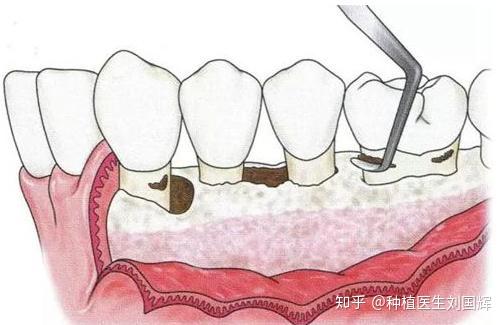 牙齿松动别急着拔这3个对策分分钟可以搞定松动牙