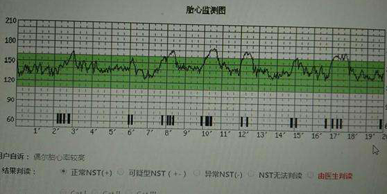 胎心率173有点过高有影响吗? 医生说正常值不高于160,会不会是缺氧?
