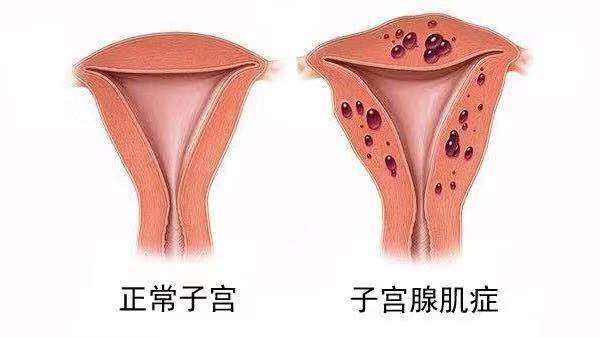 有满足这5个标准你的子宫腺肌症才算被治愈