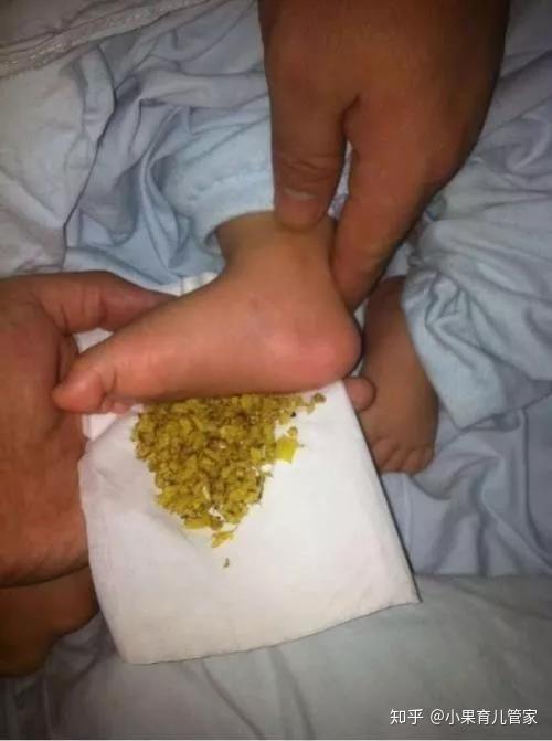 然后妈妈将炒热的姜末敷在宝宝的脚心,用白色的纱布将孩子的脚心包裹