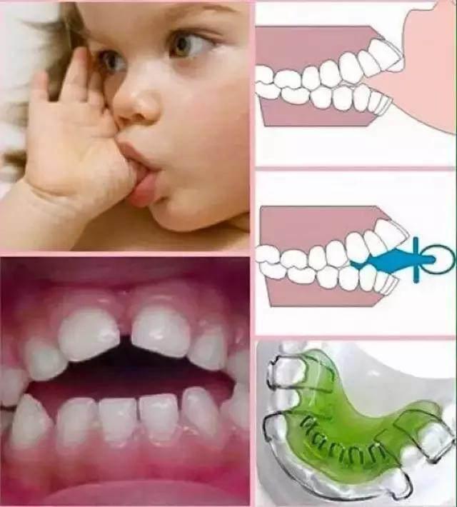 你一定没想到,宝宝吃手指会影响牙齿生长