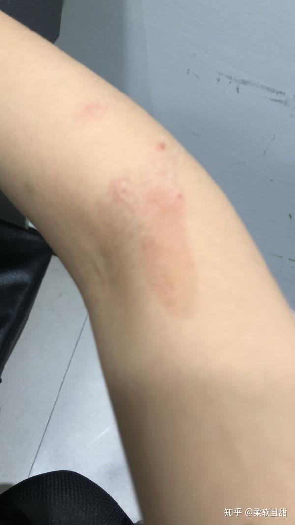 烫伤后色素沉淀