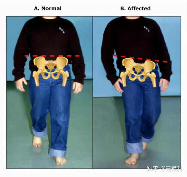 儿童跛行该如何诊断你知道吗下